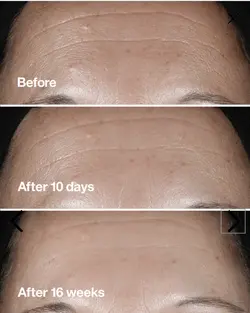 سرم ترمیم کننده و ضد چروک و کلاژن ساز  5mil smart کلینیک اورجینال