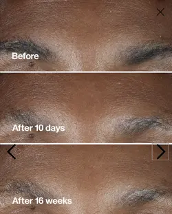 سرم ترمیم کننده و ضد چروک و کلاژن ساز  5mil smart کلینیک اورجینال