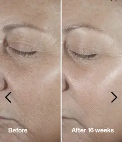 سرم ترمیم کننده و ضد چروک و کلاژن ساز  5mil smart کلینیک اورجینال