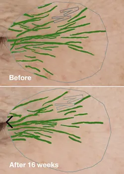 سرم ترمیم کننده و ضد چروک و کلاژن ساز  5mil smart کلینیک اورجینال