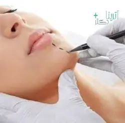 بوتاکس چانه