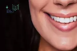 بوتاکس لبخند لثه