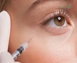 بوتاکس گوشه چشم