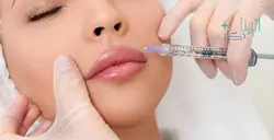 فیلر خط خنده