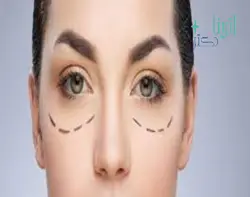 فیلر زیر چشم