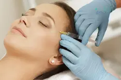 فیلر شقیقه