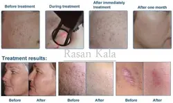 دستگاه لیزر زیبایی و جوانسازی پوست ایستاده c02 فرکشنال فوتونا Fotona Fractional Co2