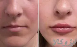 بوتاکس..لیزر بدن