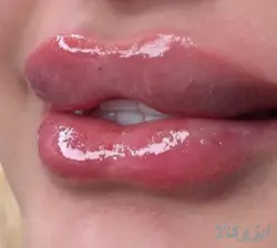 جشنواره باورنکردنی تزریق ژل و بوتاکس | ایزو کالا | بازار نیازمندیهای آنلاین ایران