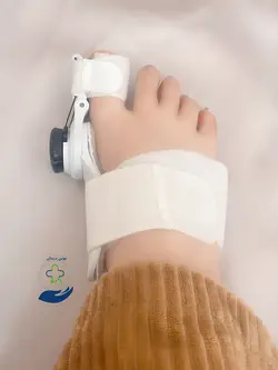 اسپلینت پیچی ( قابل تنظیم هالوکس والگوس)