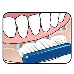 مسواک ارتو-ایمپلنت TePe