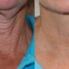 بوتاکس بدون نیاز به تزریق جوان سازی صورت و گردن