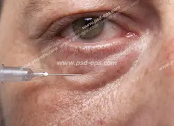 عکس با کیفیت تبلیغاتی تزریق فیلر در زیر چشم