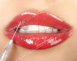 عکس با کیفیت تبلیغاتی تزریق فیلر به لب بالا