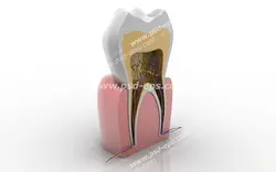 عکس با کیفیت تبلیغاتی ماکت دندان داخل لثه که از وسط دو نیم شده است