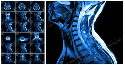 عکس با کیفیت آزمایش MRI از گردن به همراه ستون فقرات و مهره های آن جهت تشخیص دیسک گردن