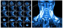 عکس با کیفیت آزمایش MRI از گردن و مهره های گردن و ستون فقرات جهت تشخیص بیماری دیسک گردن