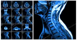 عکس با کیفیت آزمایش MRI از گردن و مهره های ستون فقرات از بیمار مبتلا به دیسک گردن