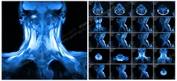 عکس با کیفیت آزمایش MRI از گردن و ستون فقرات به همراه مهره های آن جهت تشخیص بیماری دیسک گردن