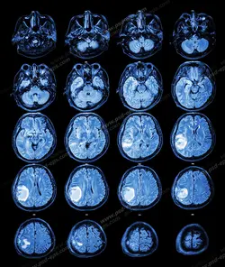 عکس با کیفیت آزمایش MRI مغزی جهت تشخیص بیماریهای مغز و اعصاب و تومورهای مغزی