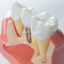 عکس با کیفیت ماکت دندان و لثه ها با دندانی کاشته شده ( ایمپلنت )