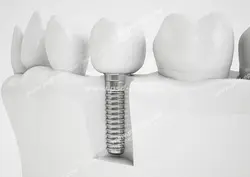 عکس با کیفیت ماکت دندان و دندان کاشته شده جهت تبلیغ ایمپلنت و کاشت دندان