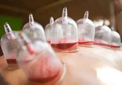 راشا افق| آیا حجامت درمانی مورد تایید جامعه پزشکی است؟