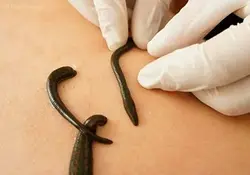 آموزش زالو درمانی چه کاربردهایی دارد؟ پولساز است؟