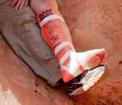 آتل آلومینیومی Sam Splint
