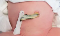 کلمپ بند ناف برند بکر