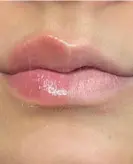 حجم دهنده لب آمپولی کیس بیوتی