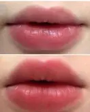 حجم دهنده لب آمپولی کیس بیوتی