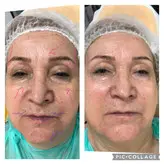 دستگاه لیفتینگ و جوانساز هایفو الترا تراپی ۲۰۲۳