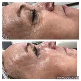 دستگاه لیفتینگ و جوانساز هایفو الترا تراپی ۲۰۲۳