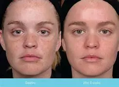 اسپری رفع آفتاب سوختگی و عرق سوز