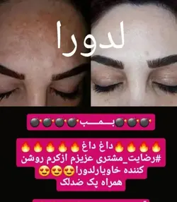 کرم ضد لک و جوش حاوی عصاره خاویار لدورا کر 50 میلی‌لیتر