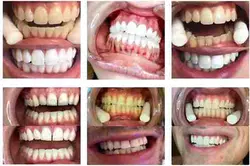 کیت بلیچینگ آفیس۳۵ درصد ۳ بیمار (بیوتی اسمایل )