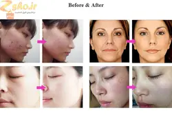 ماسک تونلی ال ای دی و کلسیم تراپی دویر مدل DEVOIR