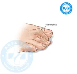 لاانگشتی هَمِر تو