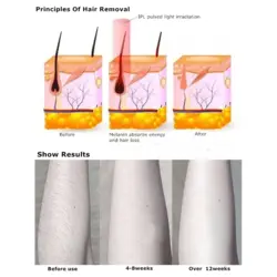 لیزر موهای زائد میسمون مدل MS-208B