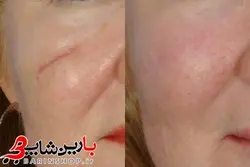 دستگاه لیزر آراف فرکشنال Fractional RF