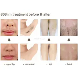 دستگاه لیزر حذف موهای زائد و تاتو 2in1 دایود Diode