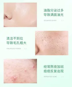 کرم ژل درمانی سالیسیلیک اسید بیواکوا