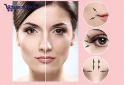 دستگاه لیزر آراف فرکشنال Fractional RF Fractional RF