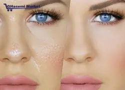 دستگاه لیزر آراف فرکشنال Fractional RF Fractional RF