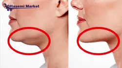 دستگاه لیزر آراف فرکشنال Fractional RF Fractional RF