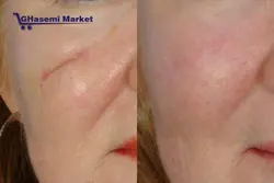 دستگاه لیزر آراف فرکشنال Fractional RF Fractional RF