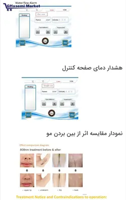 لیزر موهای زائد دیود 3 طول موج 755+1064NM+808NM