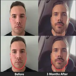 دستگاه فرم دهی صورت و زاویه فک jawline مدل FM بسته 3 عددی
