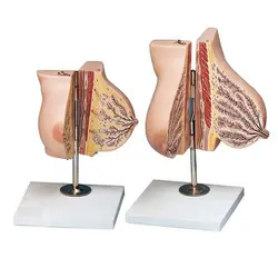 مولاژ غدد پستان در دوران شیر دهی و قبل از حاملگی